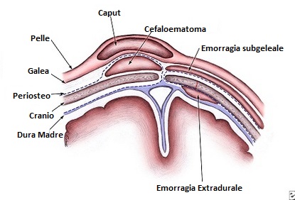 Cefaloematoma