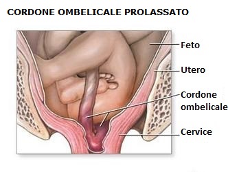 Cordone_Ombelicale_Prolassato