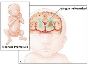 Emorragia-Intraventricolare
