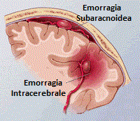Emorragia-Subaracnoidea