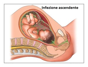 Infezione-ascendente-paralisi