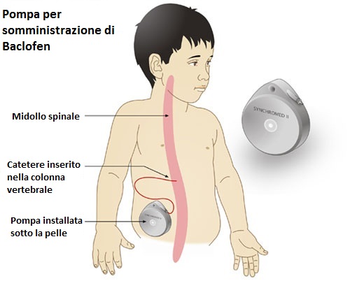 Pompa-baclofen