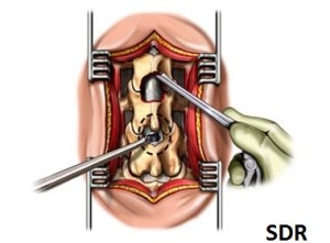 Rizotomia-dorsale-selettiva