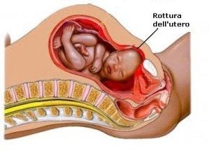 Rottura-utero