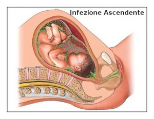 infezione-ascendente