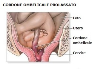 prolasso-cordone-ombellicale