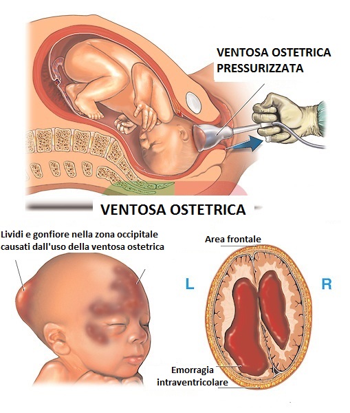 ventosa