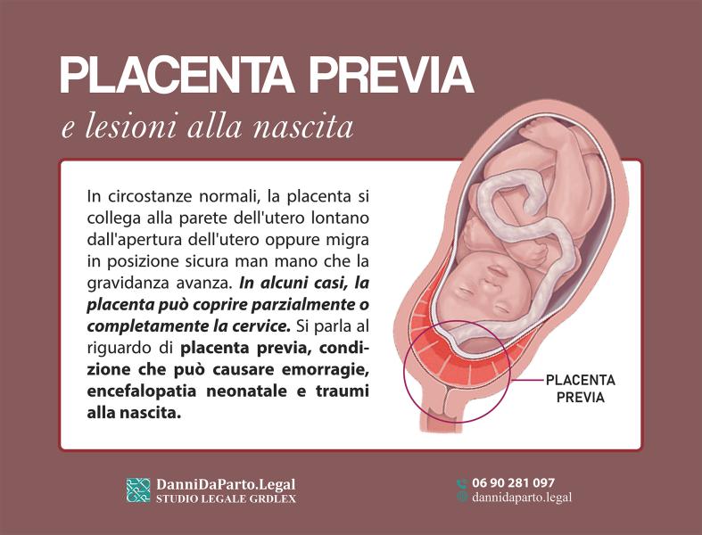 placenta-previa